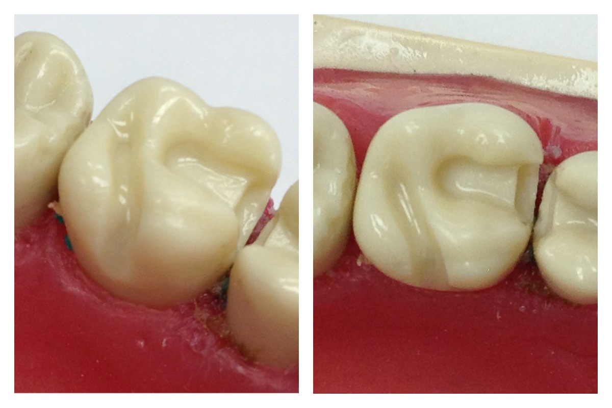 Preparing a gold inlay Mouthing Off Blog of the American Student
