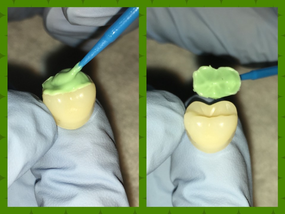 Occlusal topography made simple with a stamp ASDA Blog